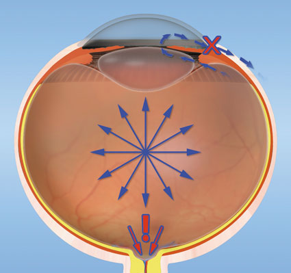 Отток внутриглазной жидкости при глаукоме