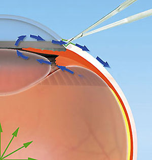 Глаукома лечение лазером стоимость кл федорова