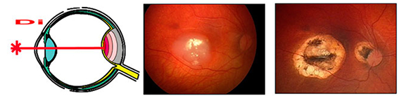 Ретинобластома глаза клиника лечение