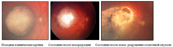 Ретинобластома глаза клиника лечение
