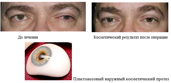 Рак глаз - причины и симптомы опухоли, лечение онкологии глаз