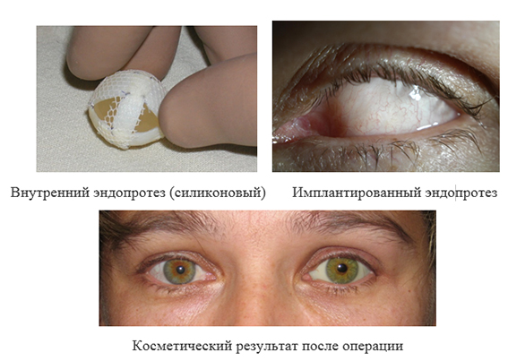 Новообразование хориоидеи глаза лечение в москве