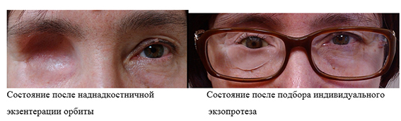 Новообразование хориоидеи глаза лечение в москве