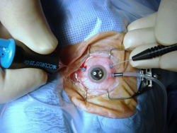 Хирургия глаукомы в москве