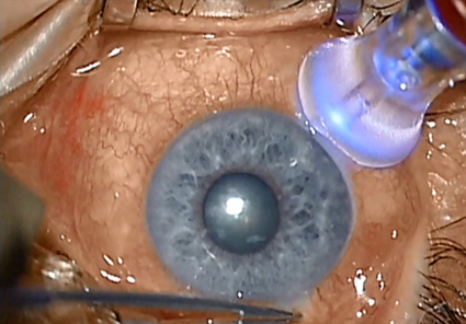 Микрохирургия глаза глаукома операции