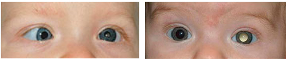 Ретинобластома глаза у детей лечение в россии