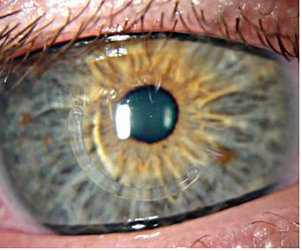 Клиники микрохирургии глаза пересадка роговицы